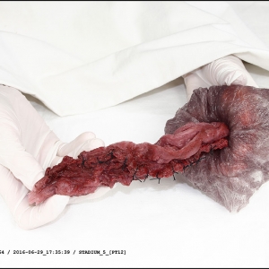 malatsion, "Genese/genesen, treatment sheet for ID_007ML  at stage 5", 2016-2017