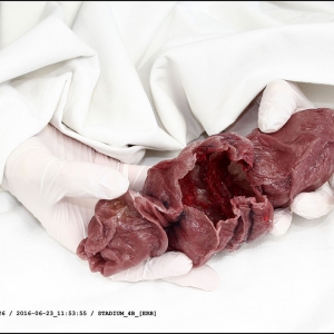 malatsion, "Genese/genesen, treatment sheet for ID_013GL  at stage 4B", 2016-2017
